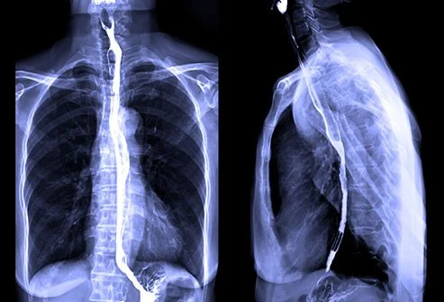 X-ray Barium Swallow Upper Gastrointestinal